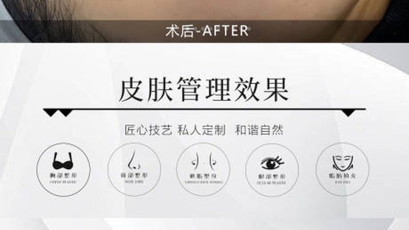 韩式三点双眼皮，学生族美丽升级的选择