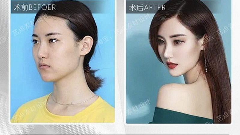 成都激光脱毛与冰点脱毛：原理与区别解析