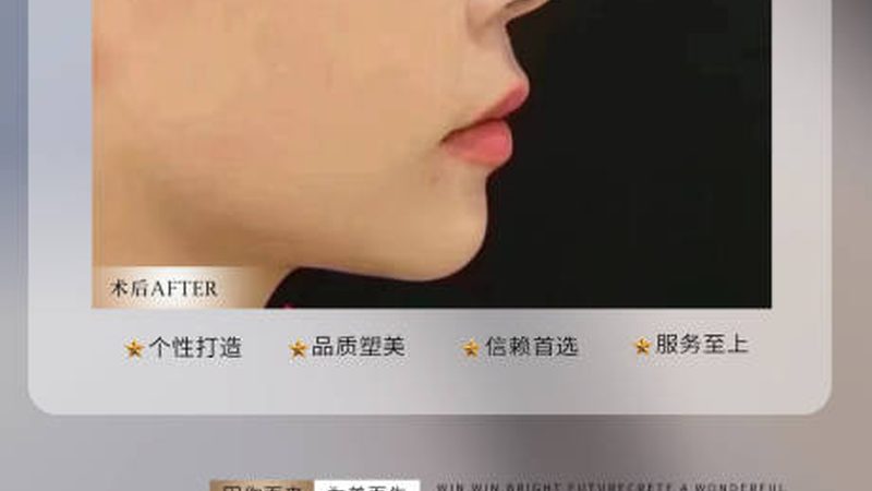 注射美容肉毒素哪个牌子好
