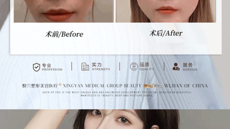 超声炮面部提升加盟代理，你了解多少？**