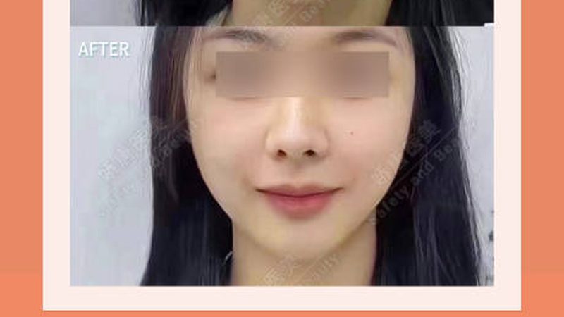 小标题：隆鼻手术原理