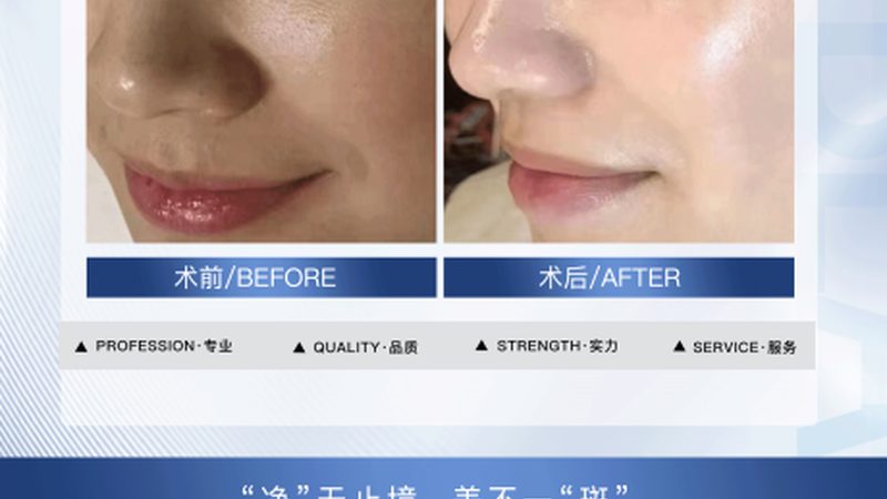激光祛斑仪器功率参数区别
