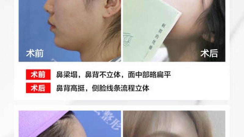 激光祛斑具有以下优势：