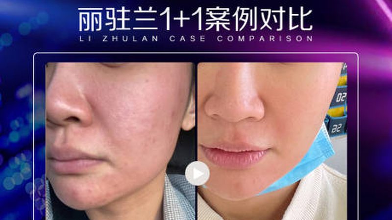 美容抗衰射频仪：揭秘其背后的技术与资质
