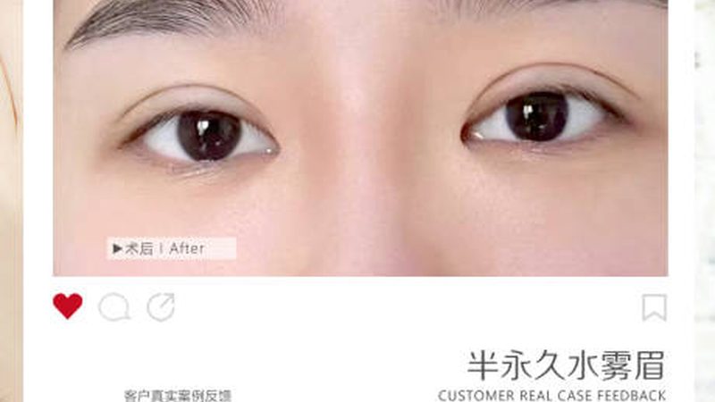 国产玻尿酸与进口玻尿酸：价格背后的差异解析